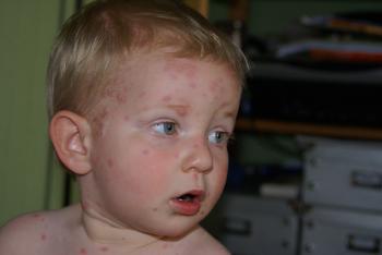 La varicela: situación actual, cómo reconocerla y cómo tratarla