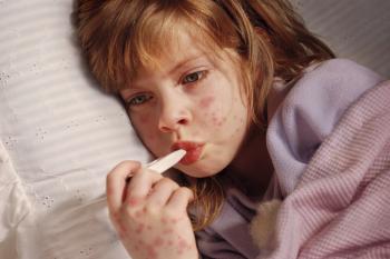 Enfermedad de mano, pie y boca, una infección viral común entre niños