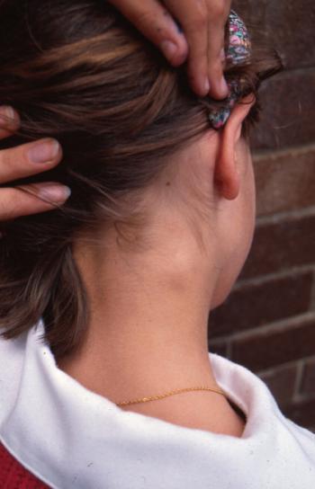 Gangli marcat en el coll d'una nena 