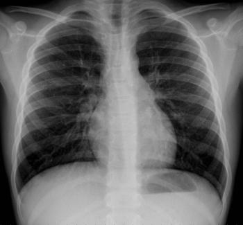 Radiografia de tòrax d'un nen