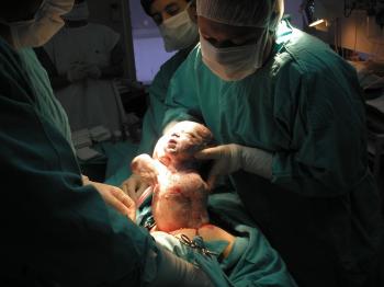 Tipus d'anestèsia en cas de cesària