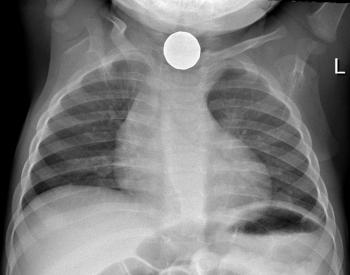 Radiografía de un menor con un cuerpo extraño alojado en el esófago