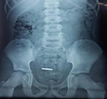 Radiografía cuerpo extraño
