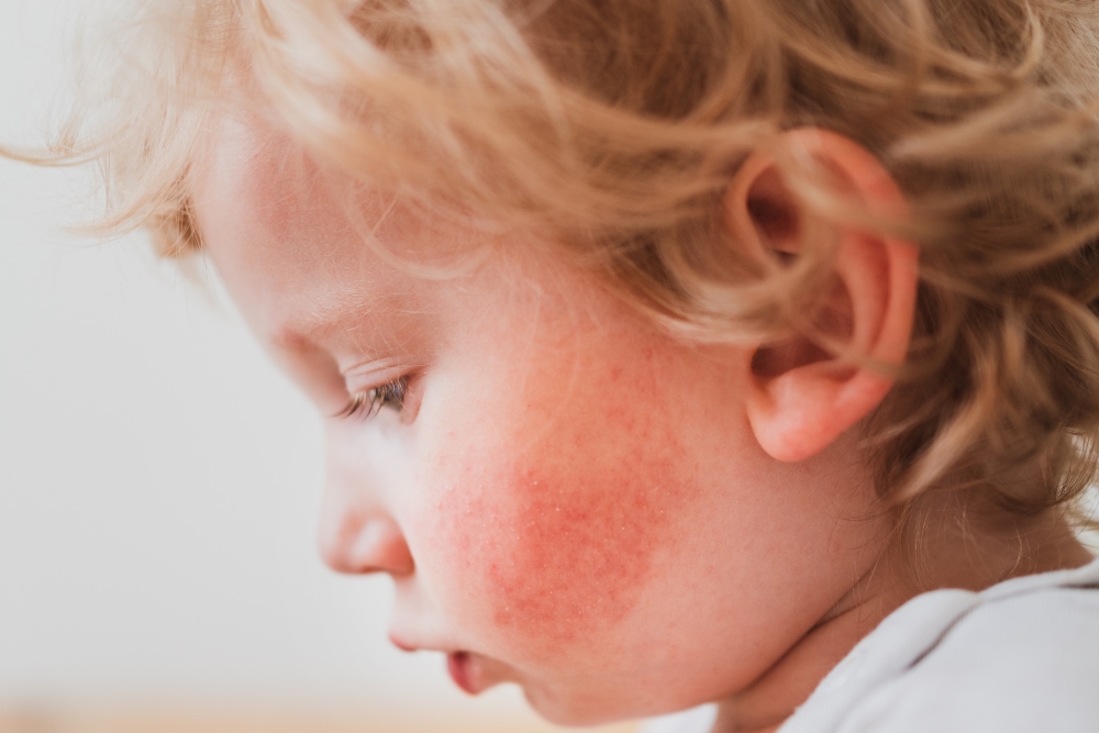 niño con dermatomiosiis juvenil