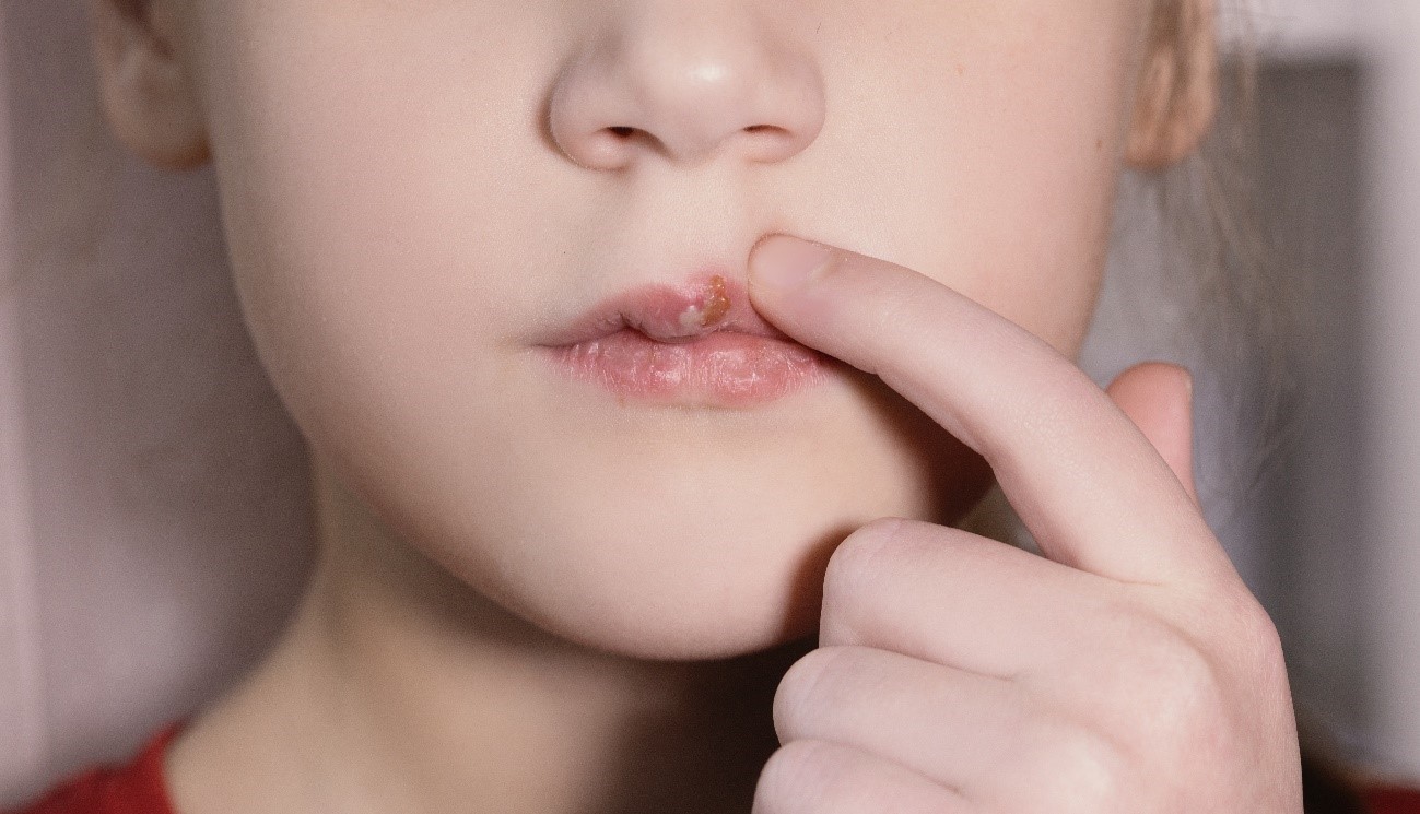 Herpes labial en niños, por qué ocurre y cómo acabar con él