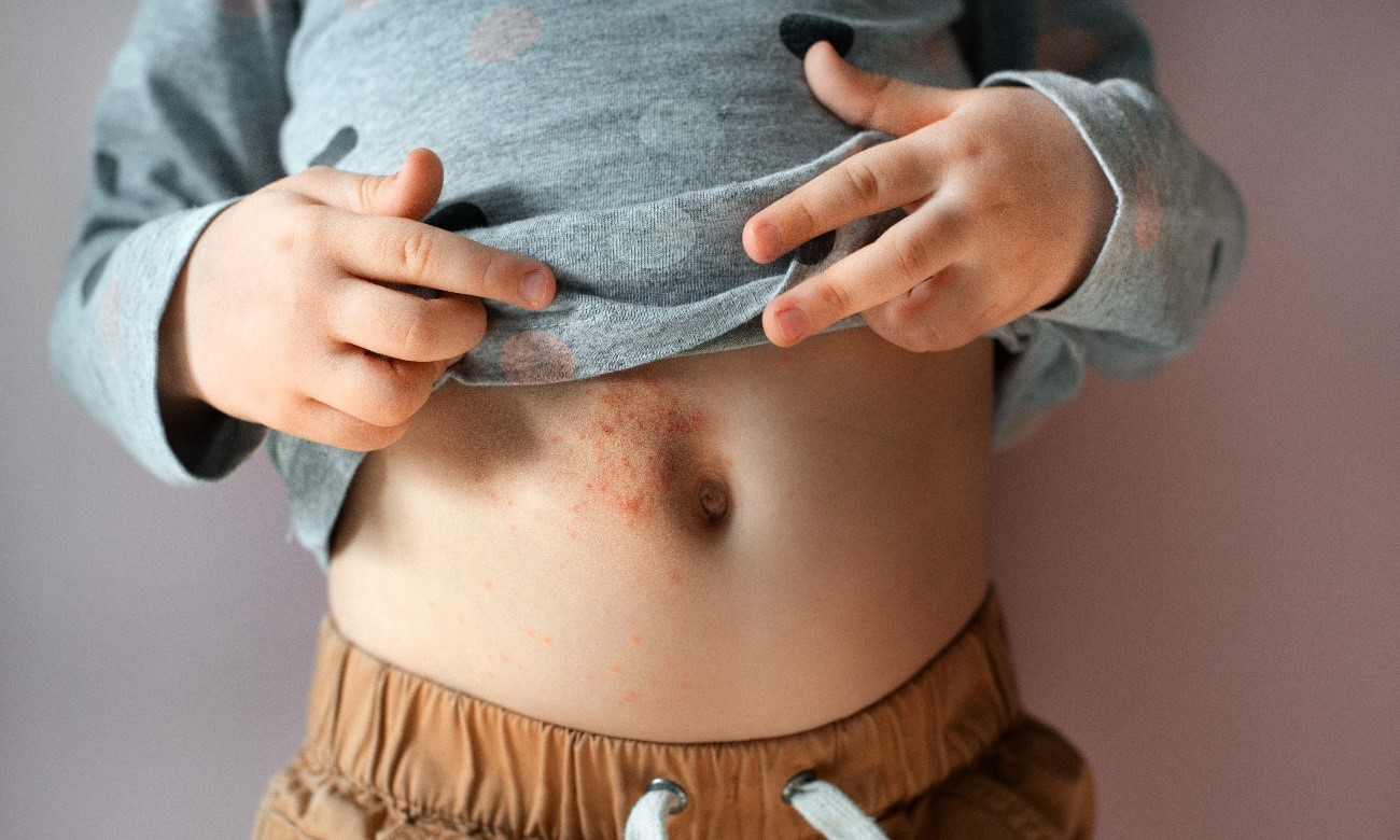 Niño con herpes zóster en la barriga