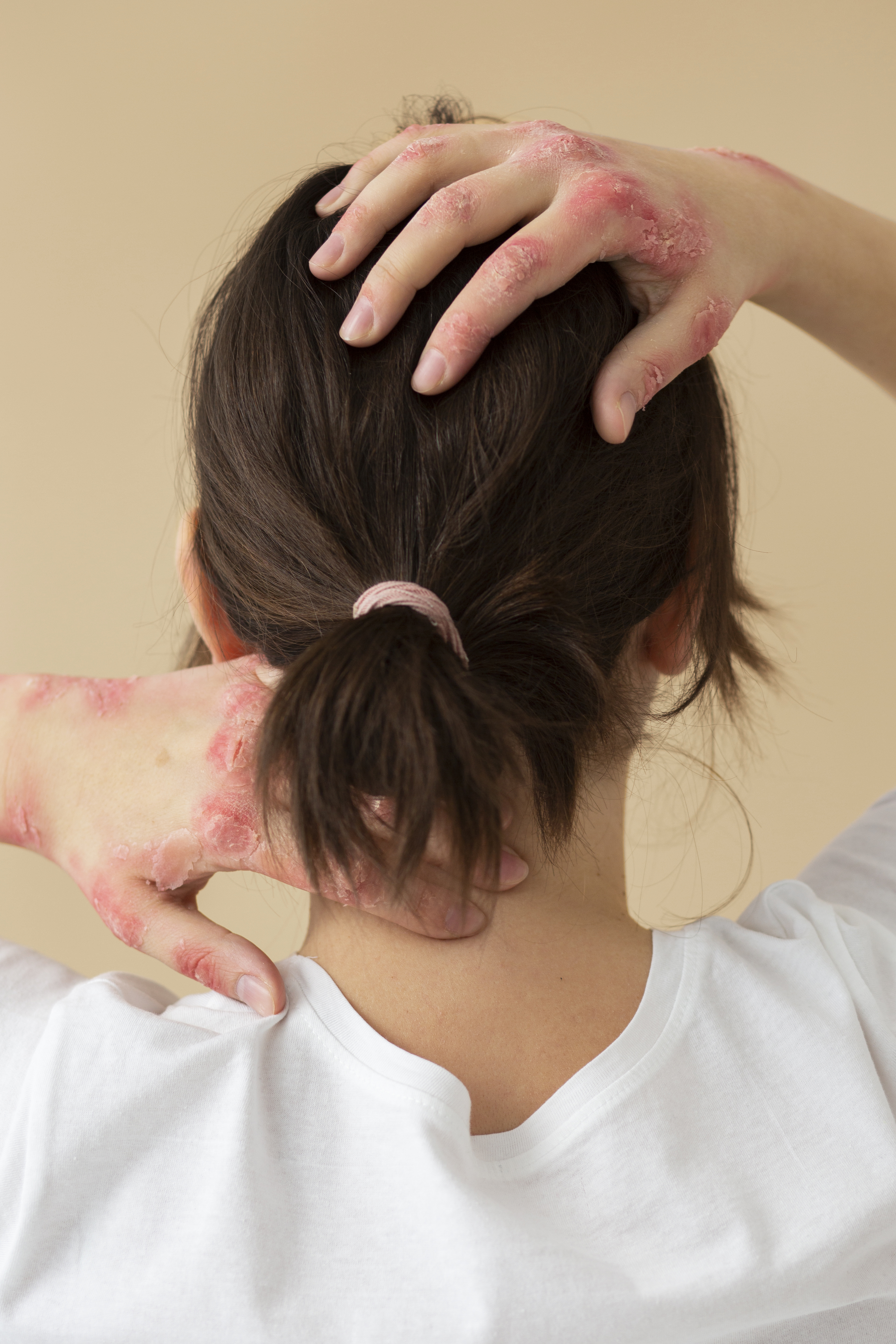 Persona con psoriasis en las manos