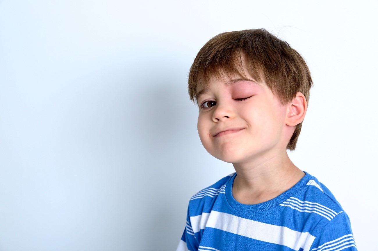 Niño con el parpado inflamado