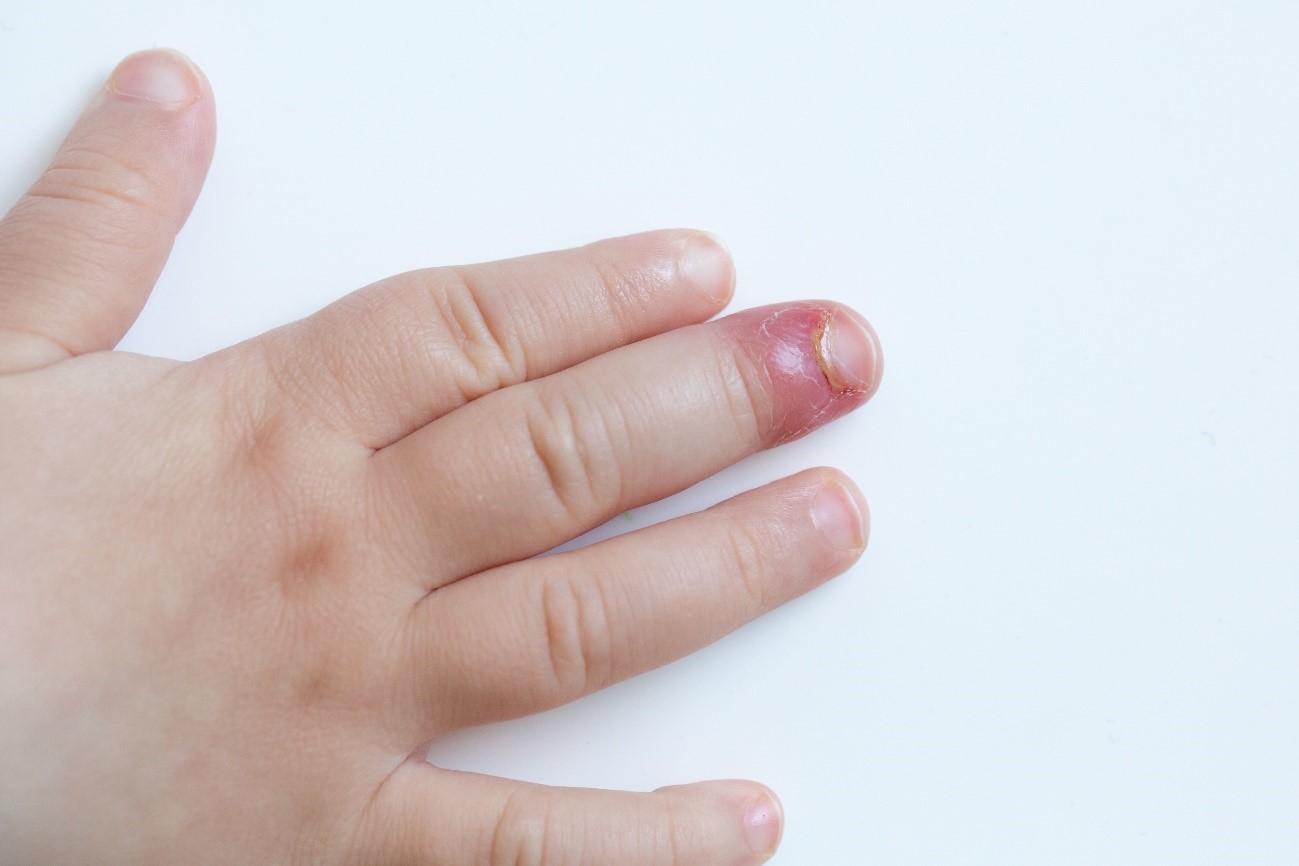 Niño con paroníquia en dedo de la mano