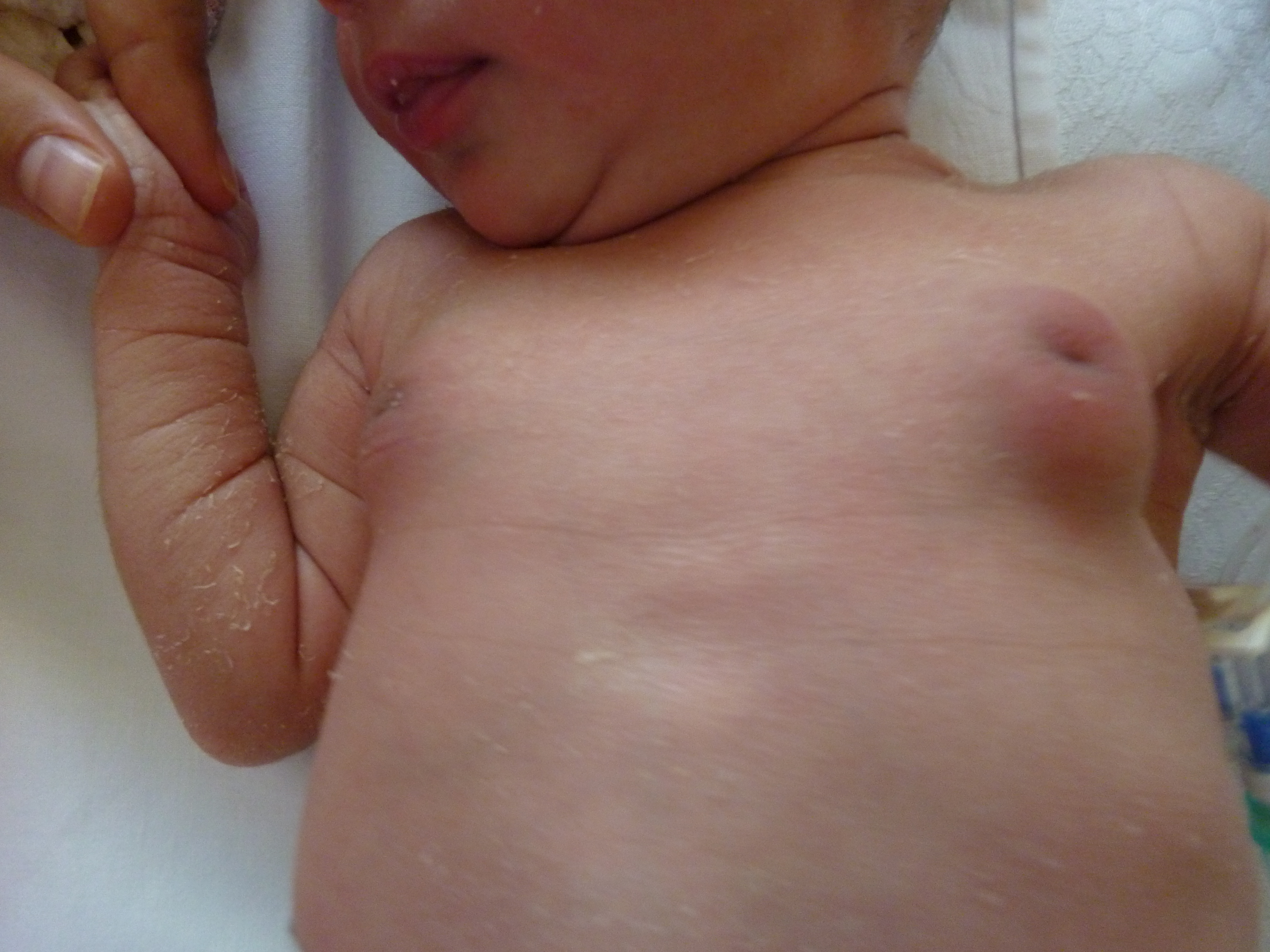 Intumescencia mamaria del recién nacido. 