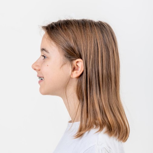Perfil nena rinoplastia