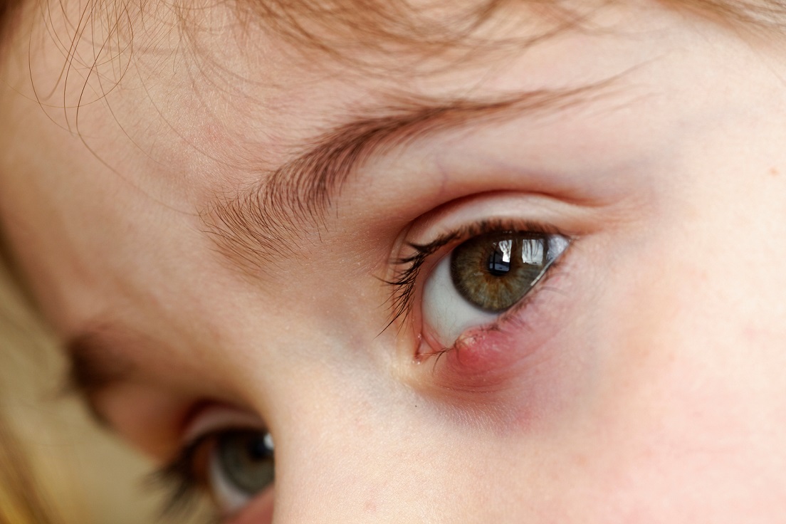 Niña con orzuelo en el ojo - Imagen de adobe stock