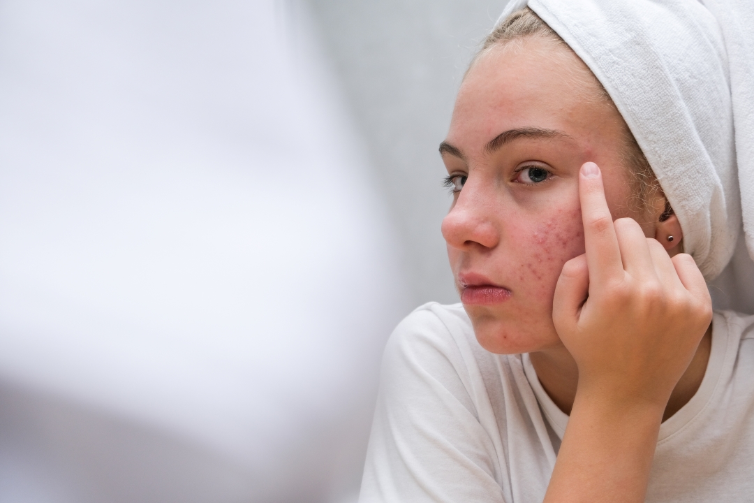 Niña con acné ante el espejo