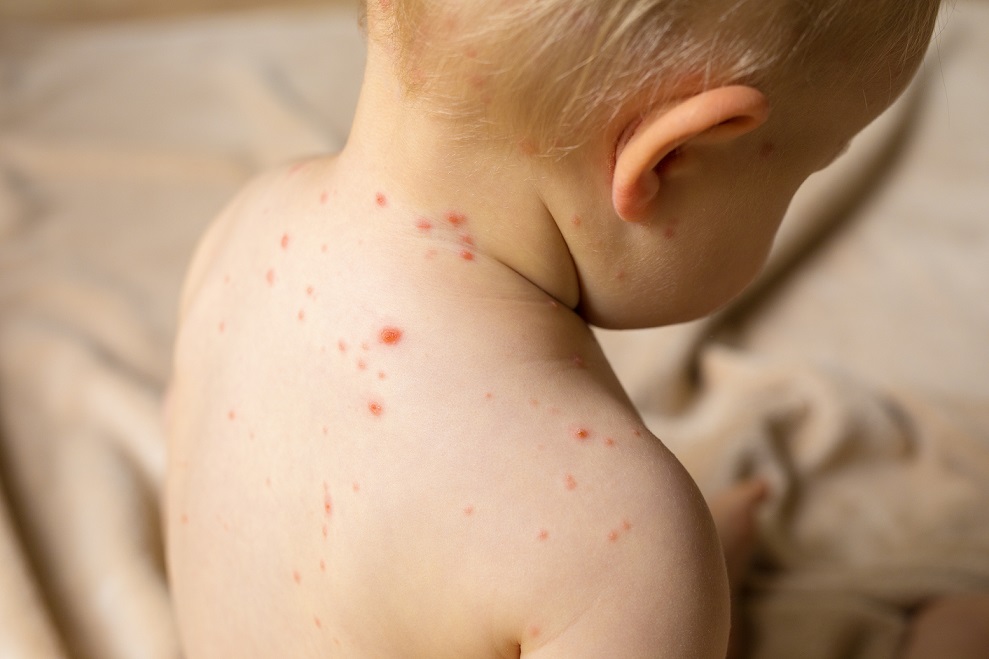 Niño con varicela - Imagen de adobe stock