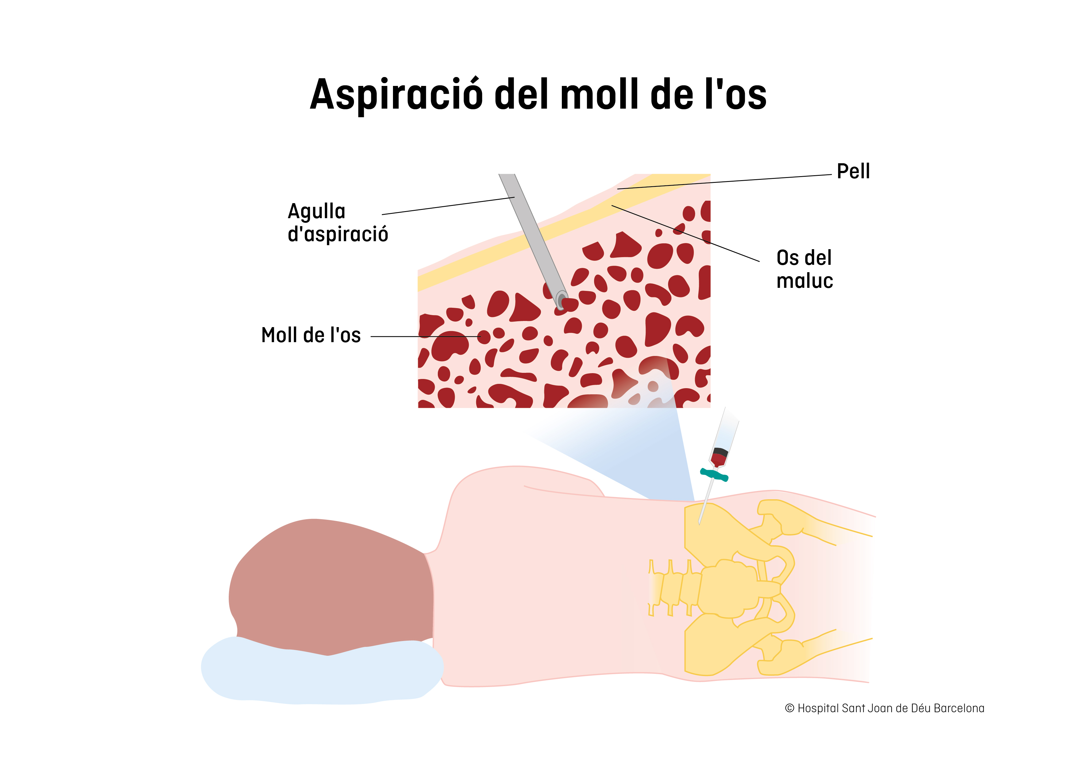 Aspiración de médula ósea