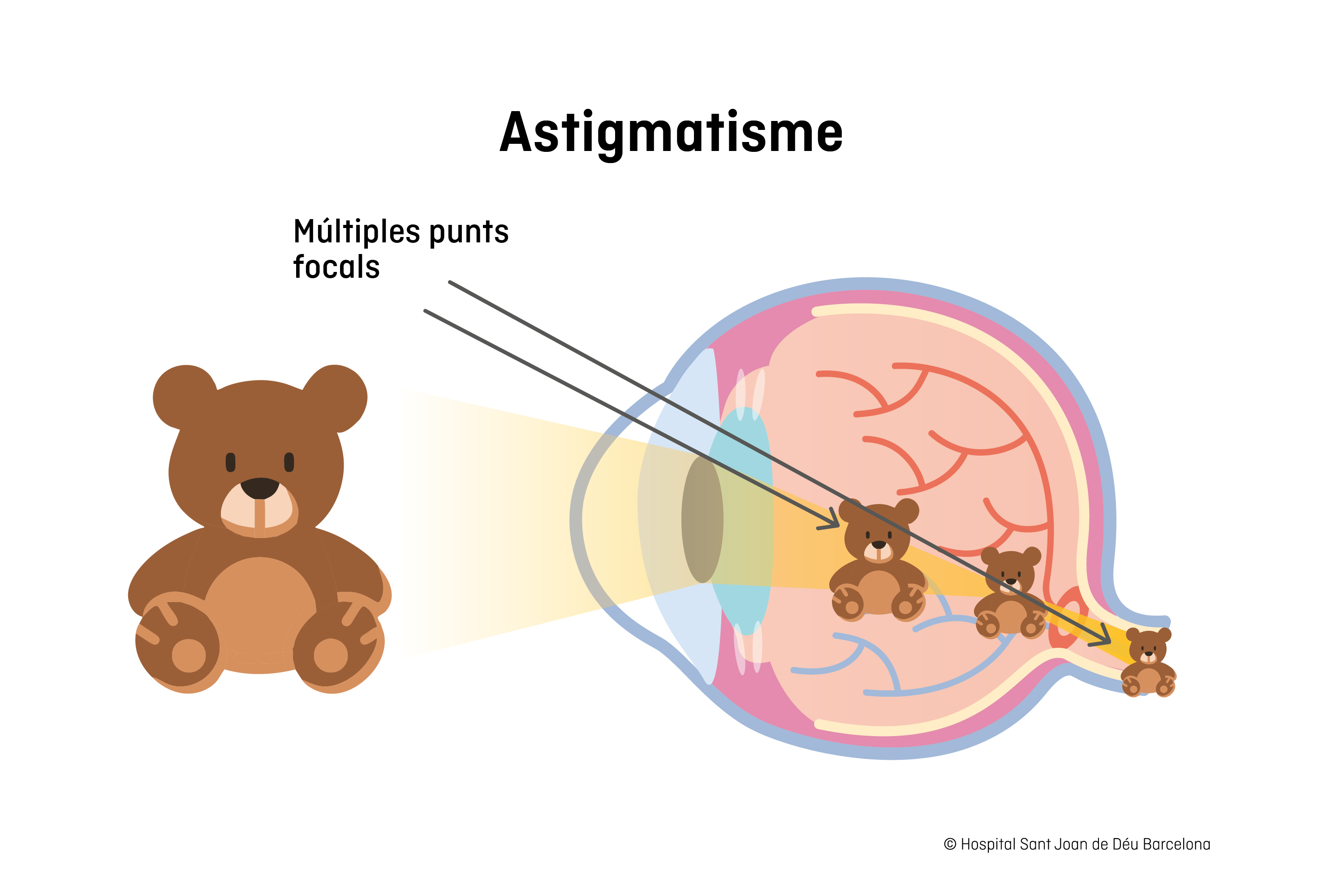 Astigmatisme