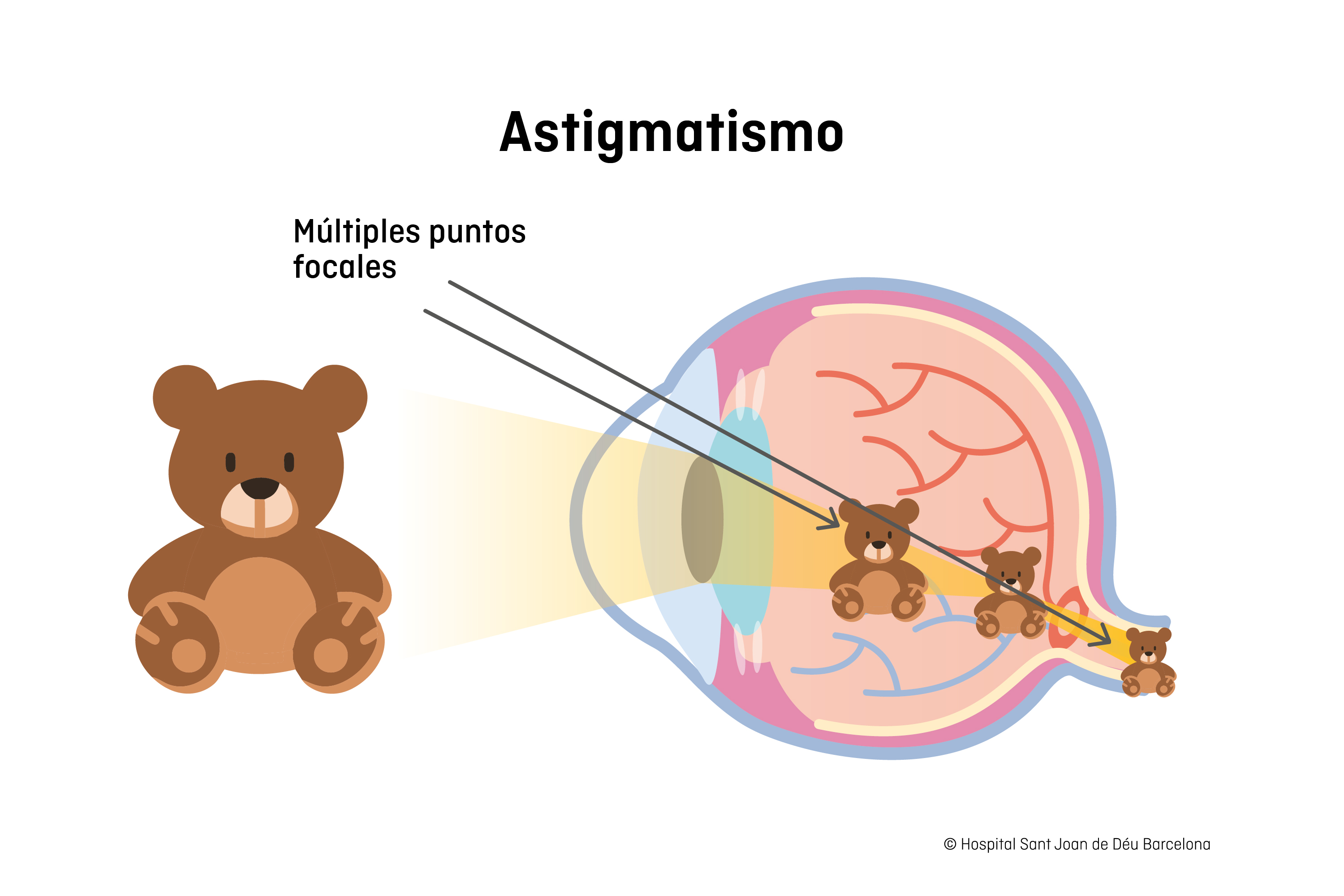 Astigmatismo