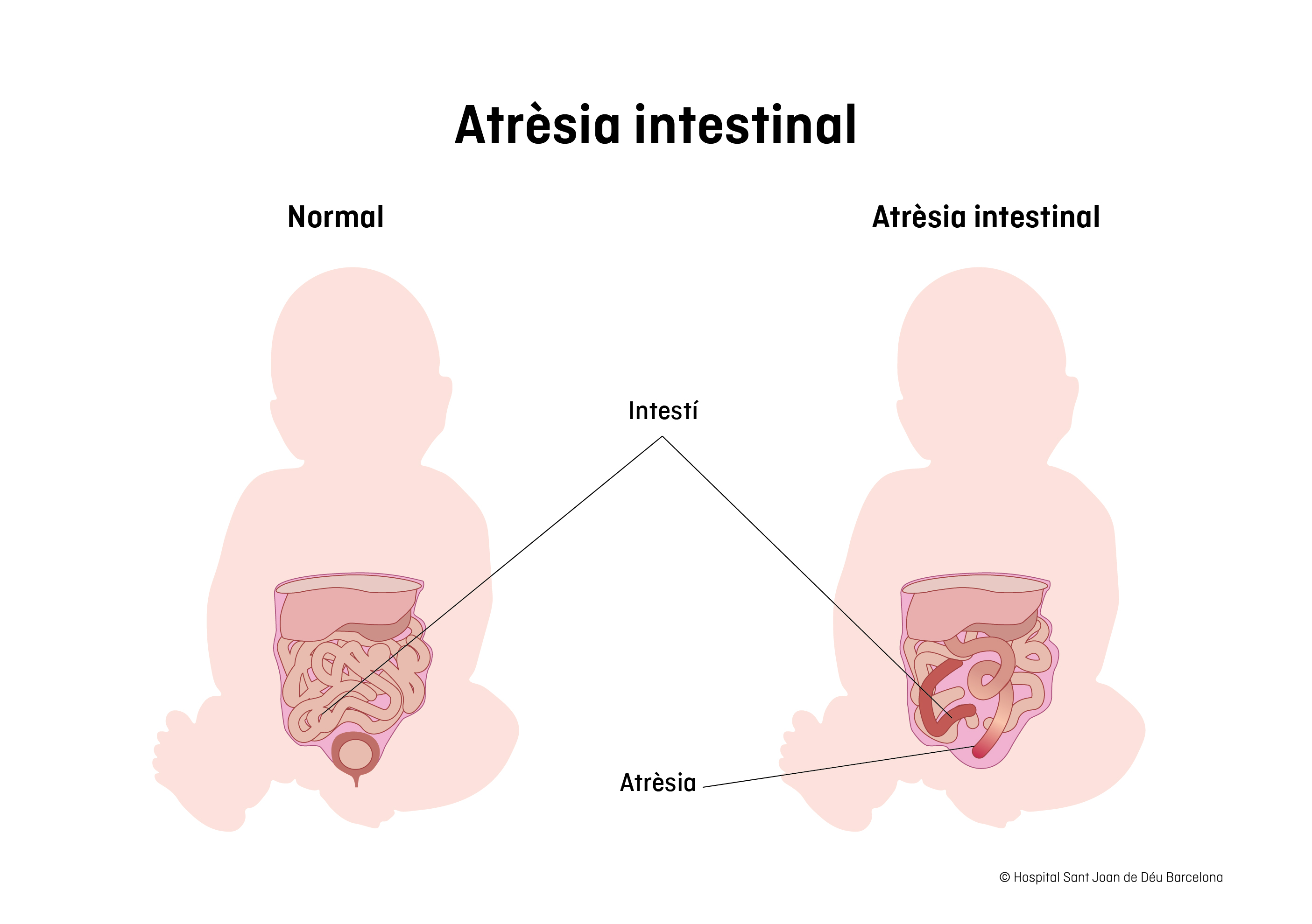 Atrèsia intestinal