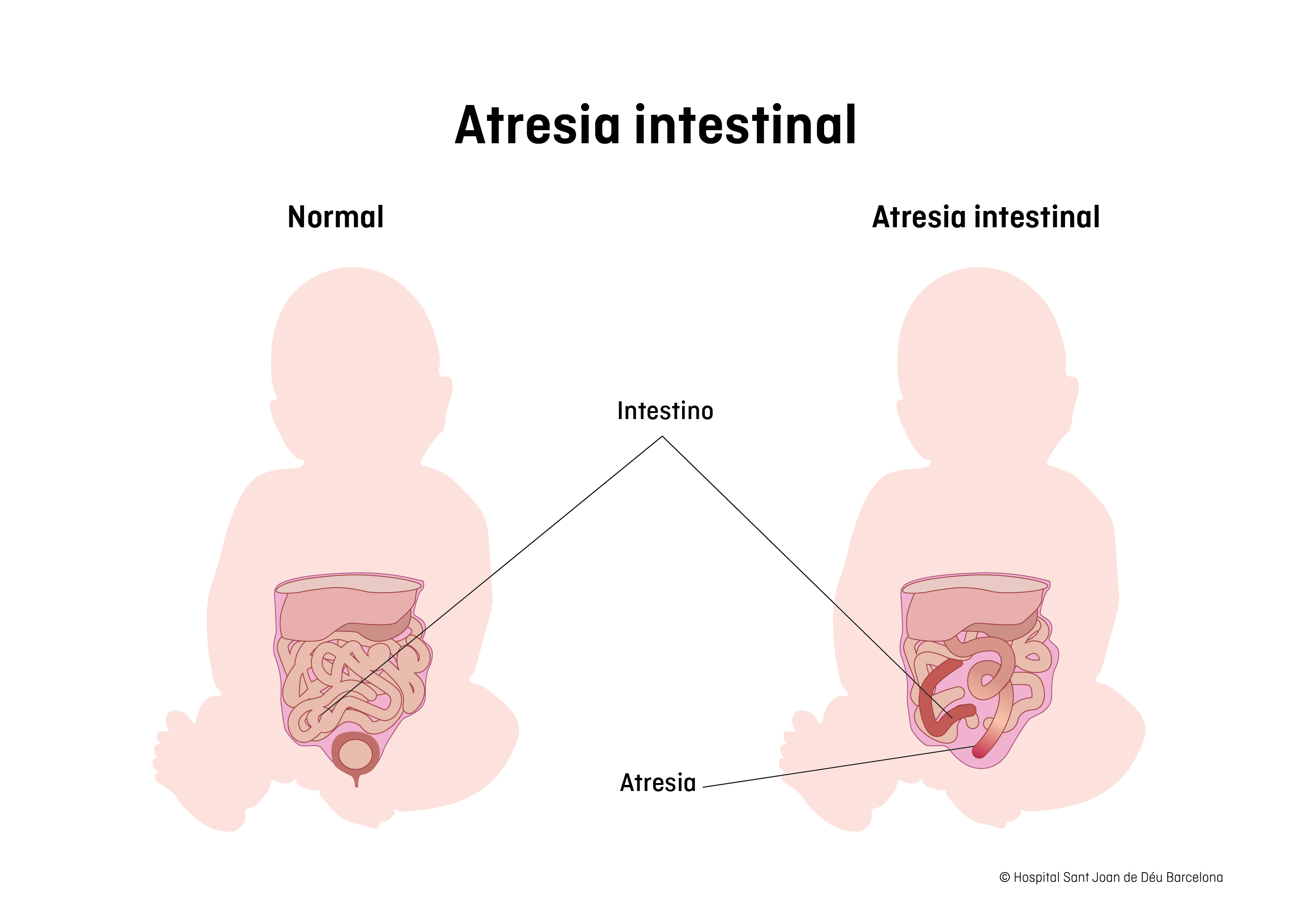 Atresia intestinal