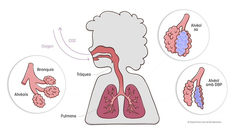 bronquiolitis