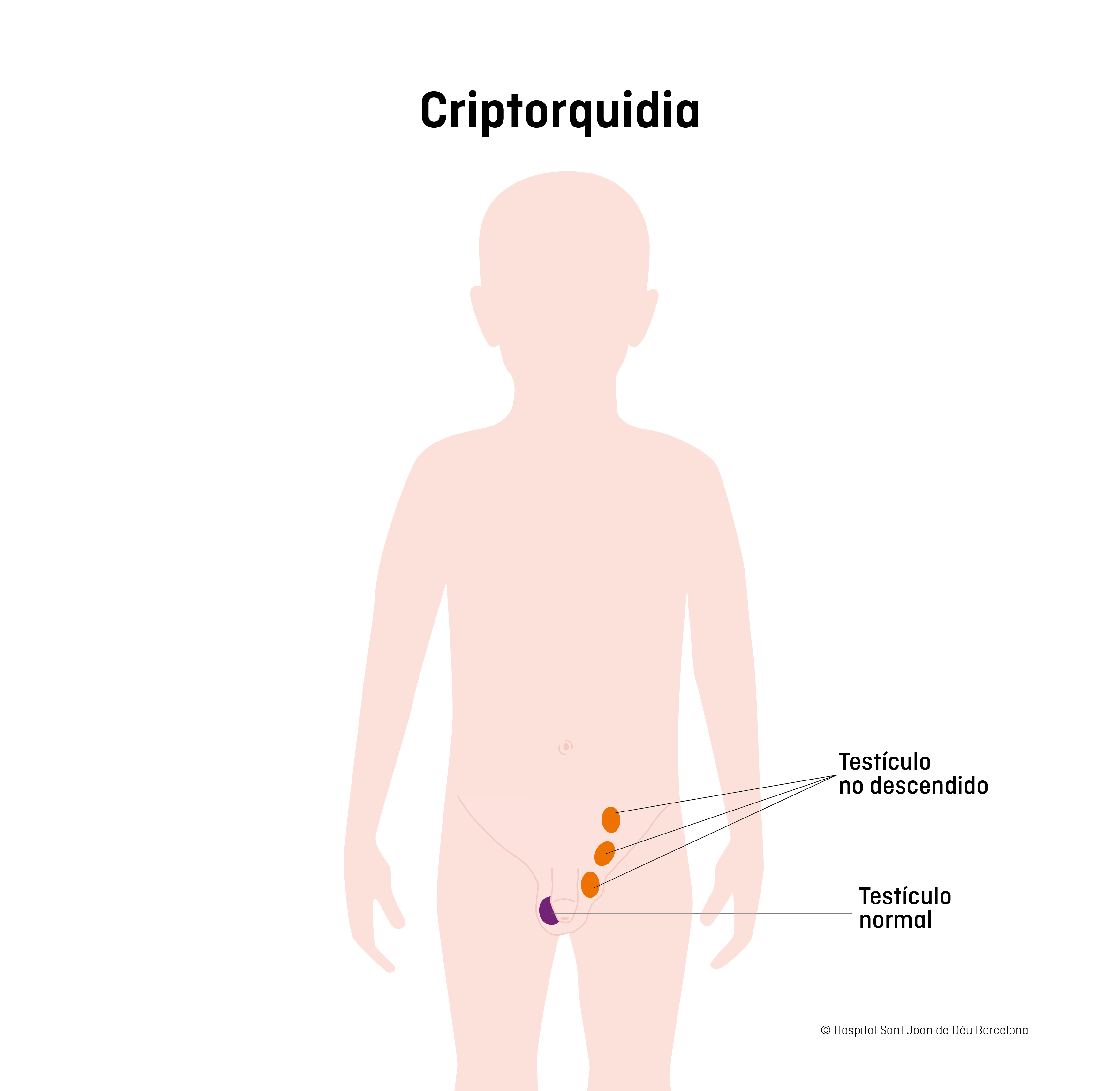 Criptorquídia