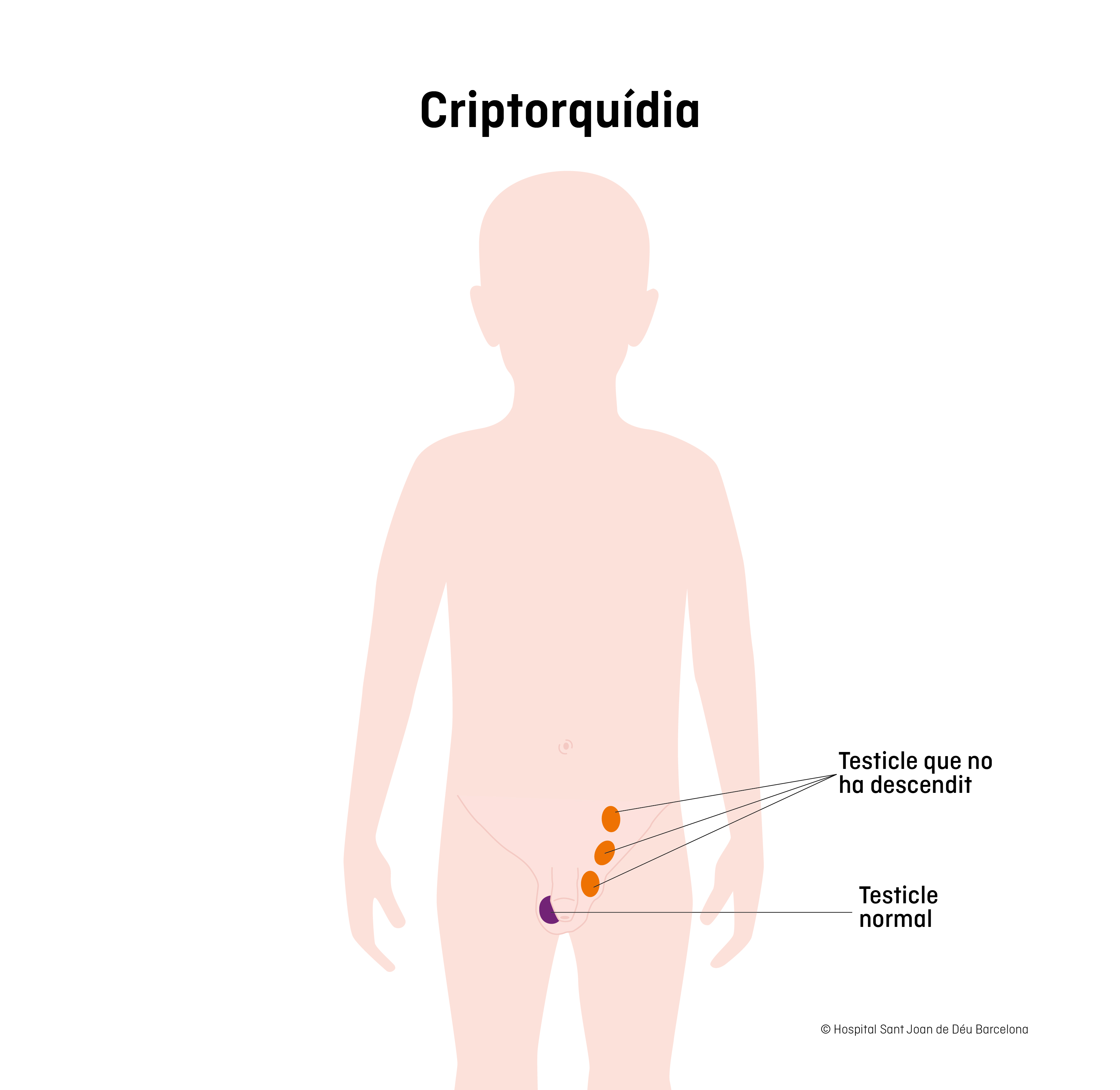 Criptorquidia