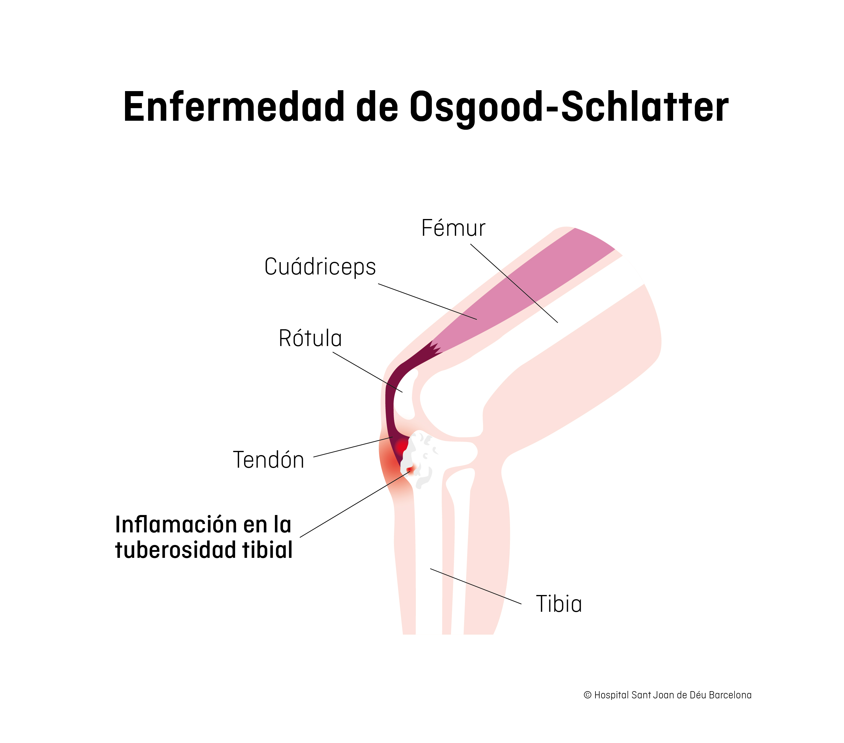 Enfermedad de Osgood-Schlatter