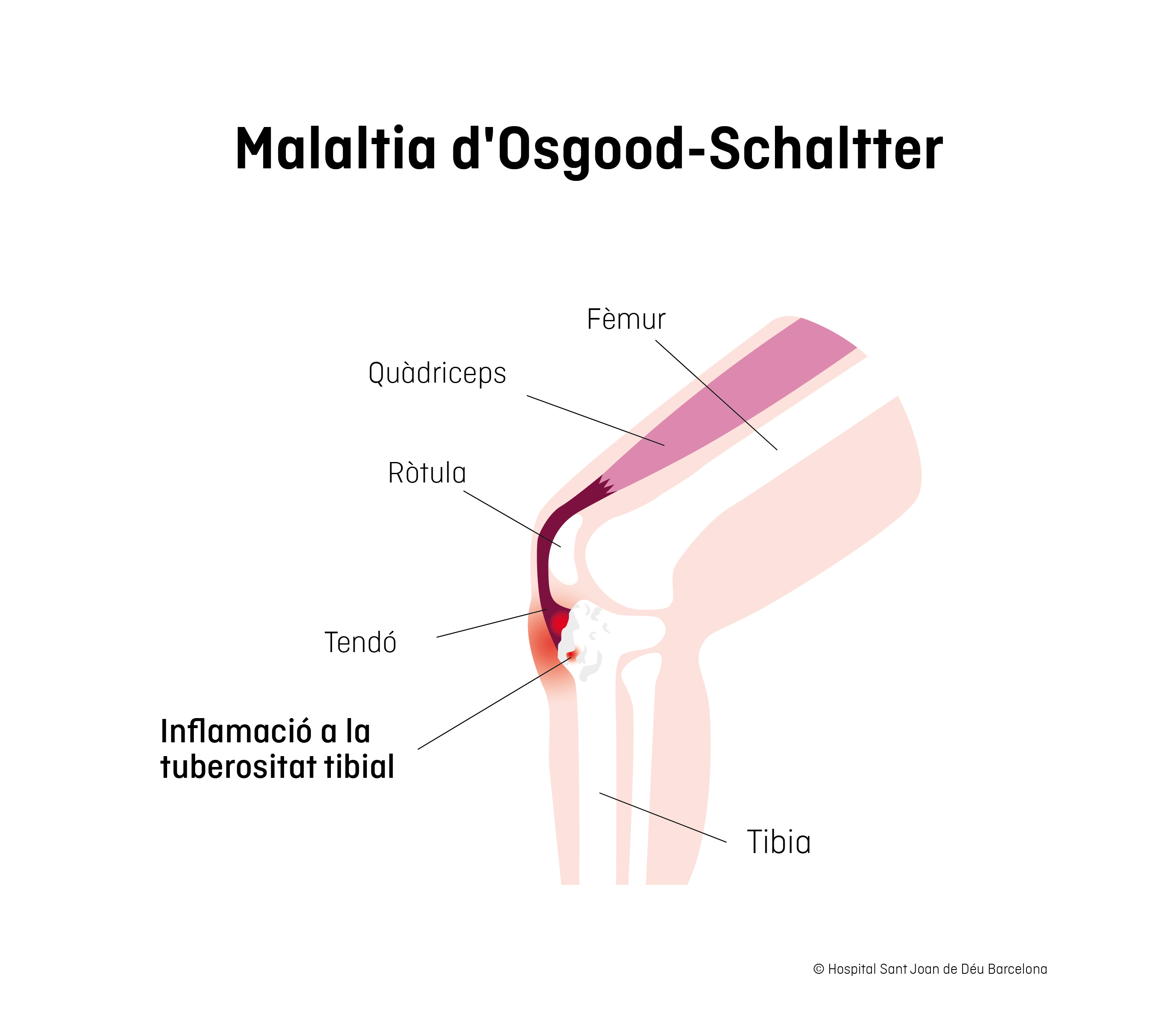 Enfermedad d'Osgood-Schlater