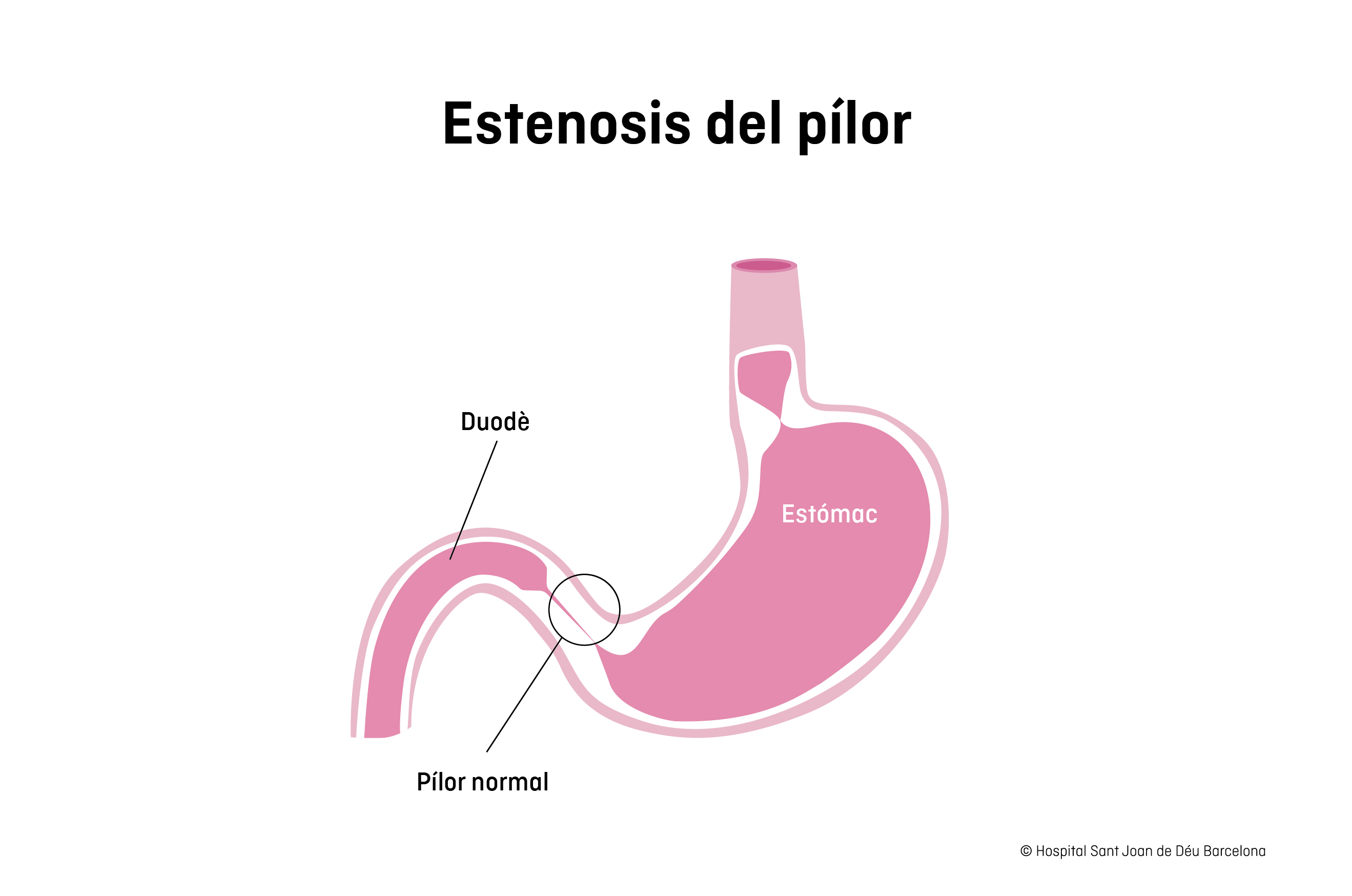 Estenosis pilòrica