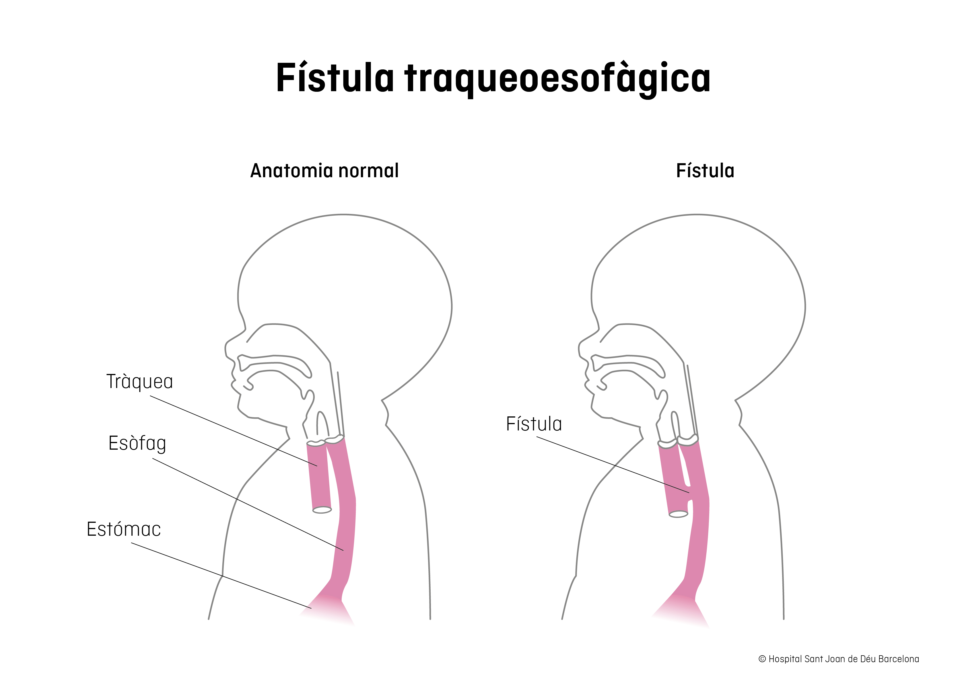 Fístula traqueosofàgica