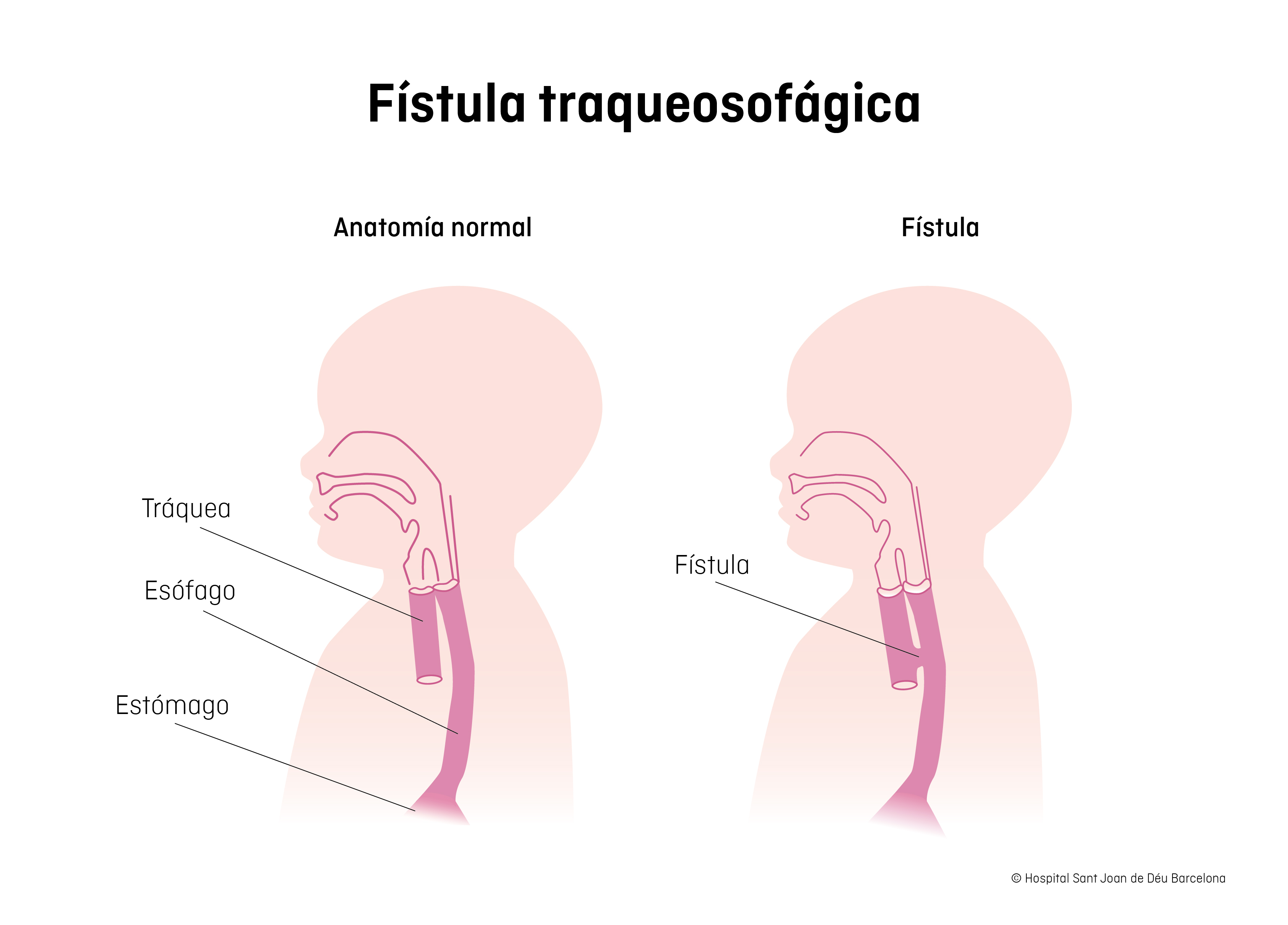 Fístula traqueosofágica