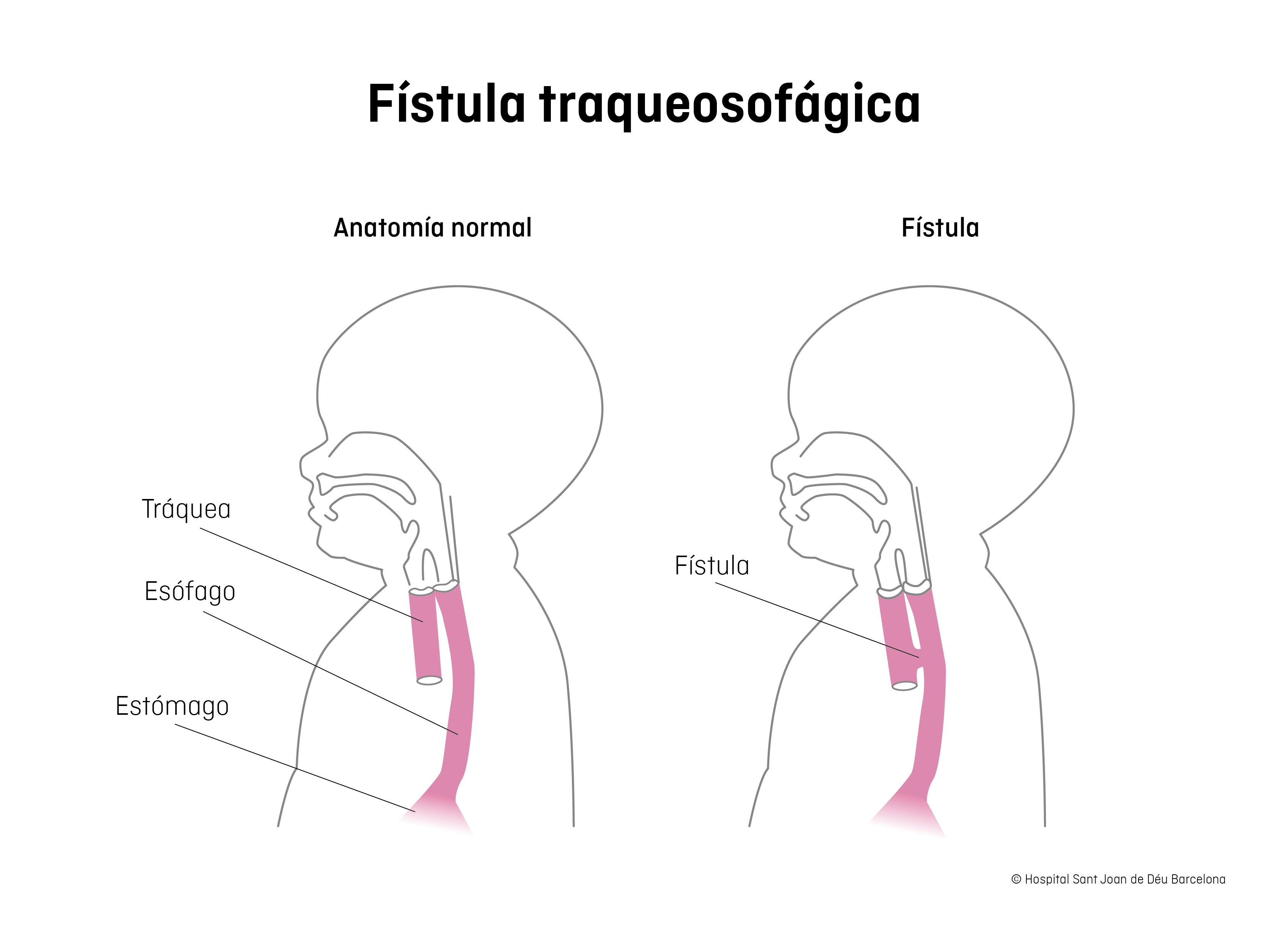 Fístula traqueosofágica