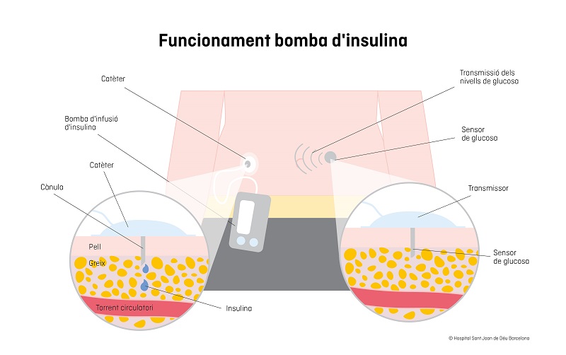 funcionament infusor d'insulina
