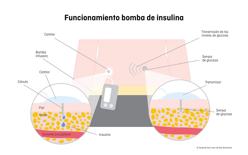 funcionament bomba insulina