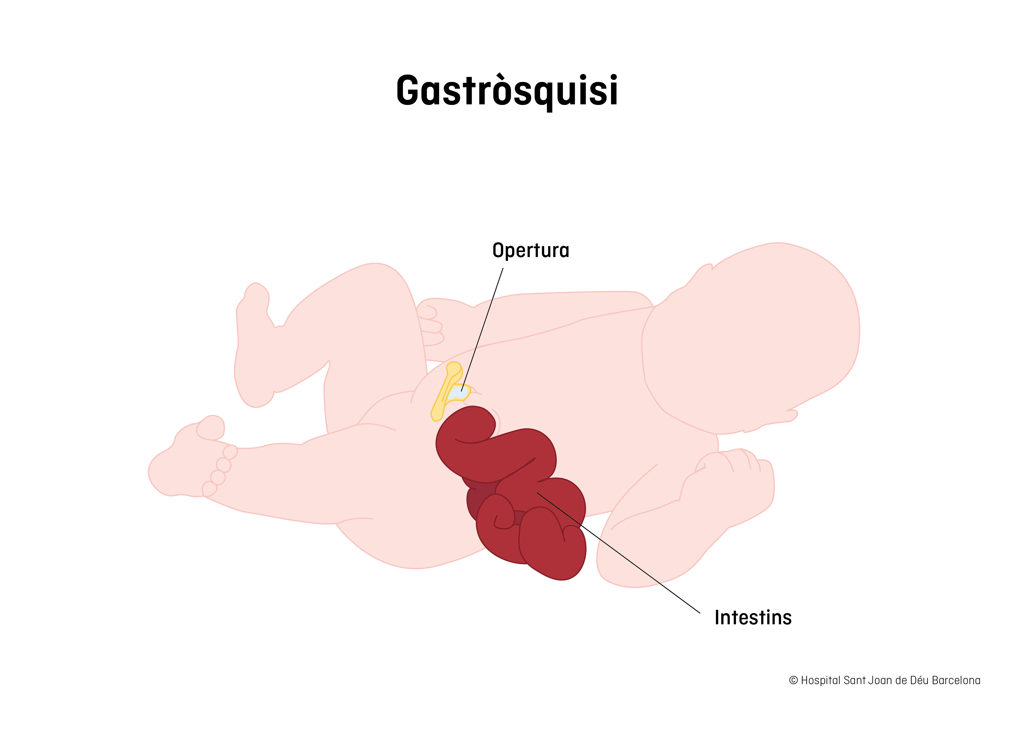 Gastrosquisis