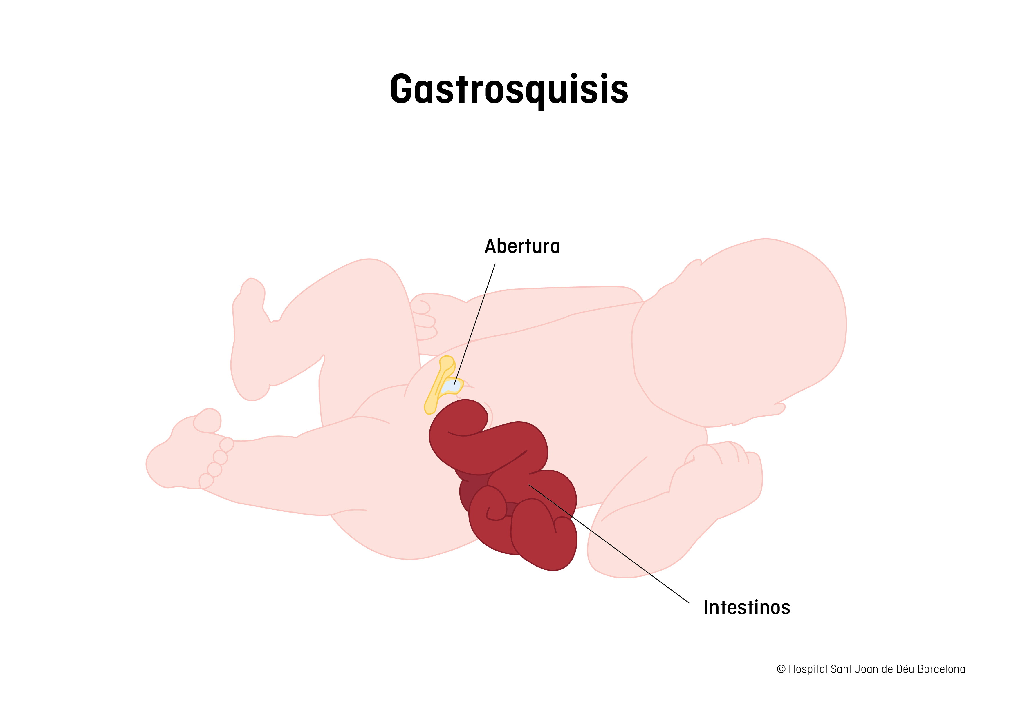 Gastrosquisis