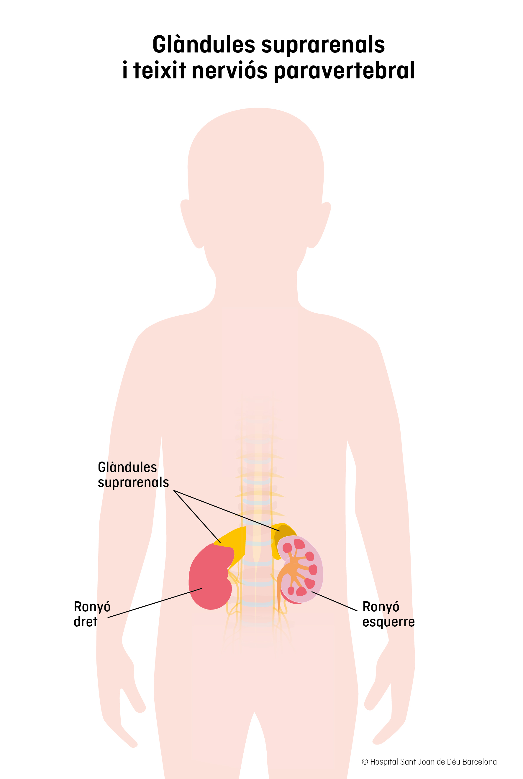 Neuroblastoma