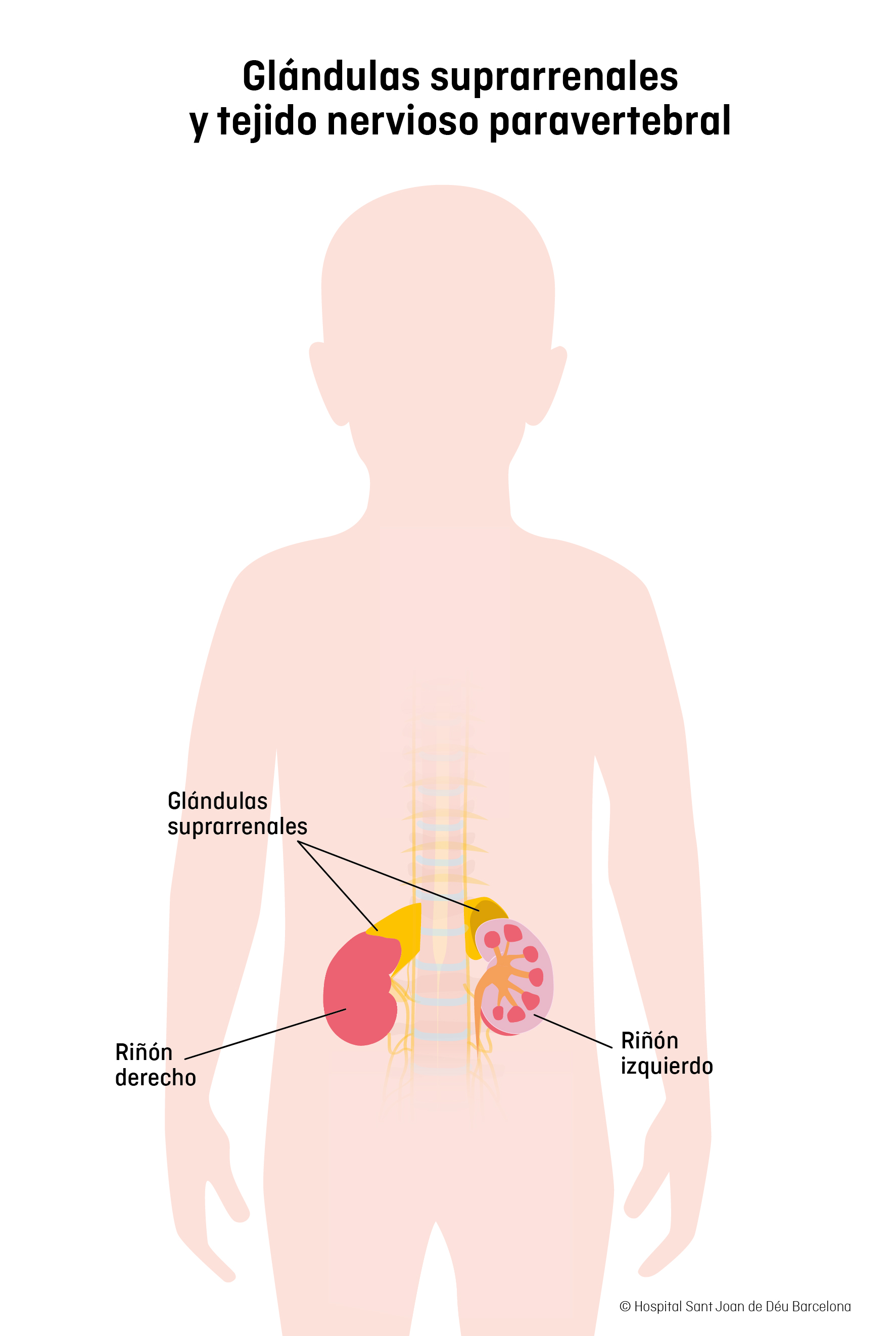 Neuroblastoma