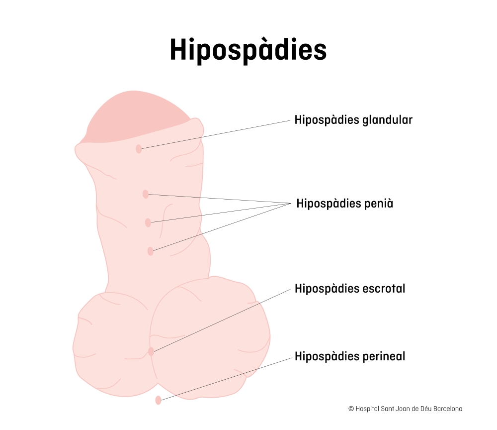 Dibuix d'un penis amb hipospádia