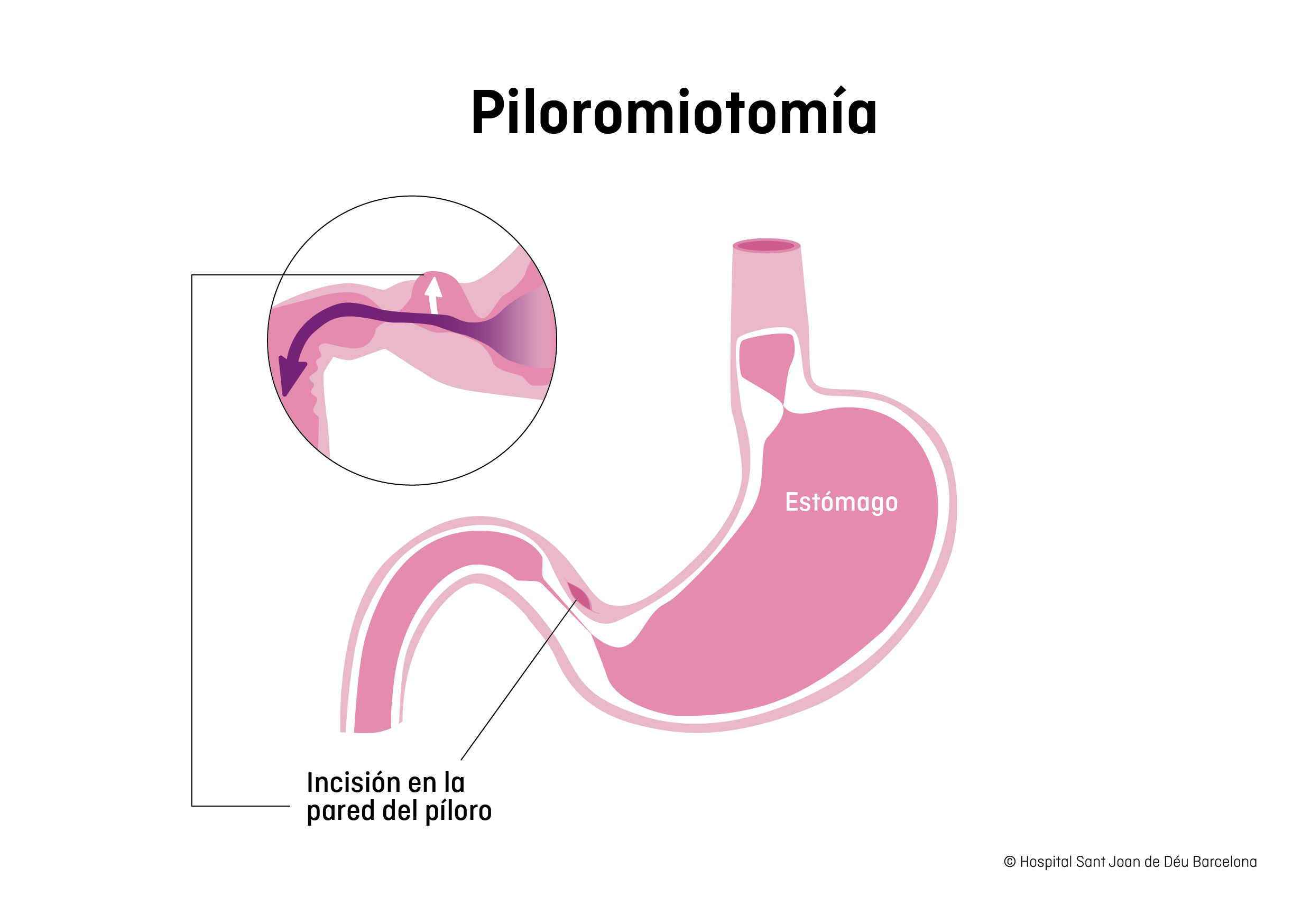 Piloromiotomía