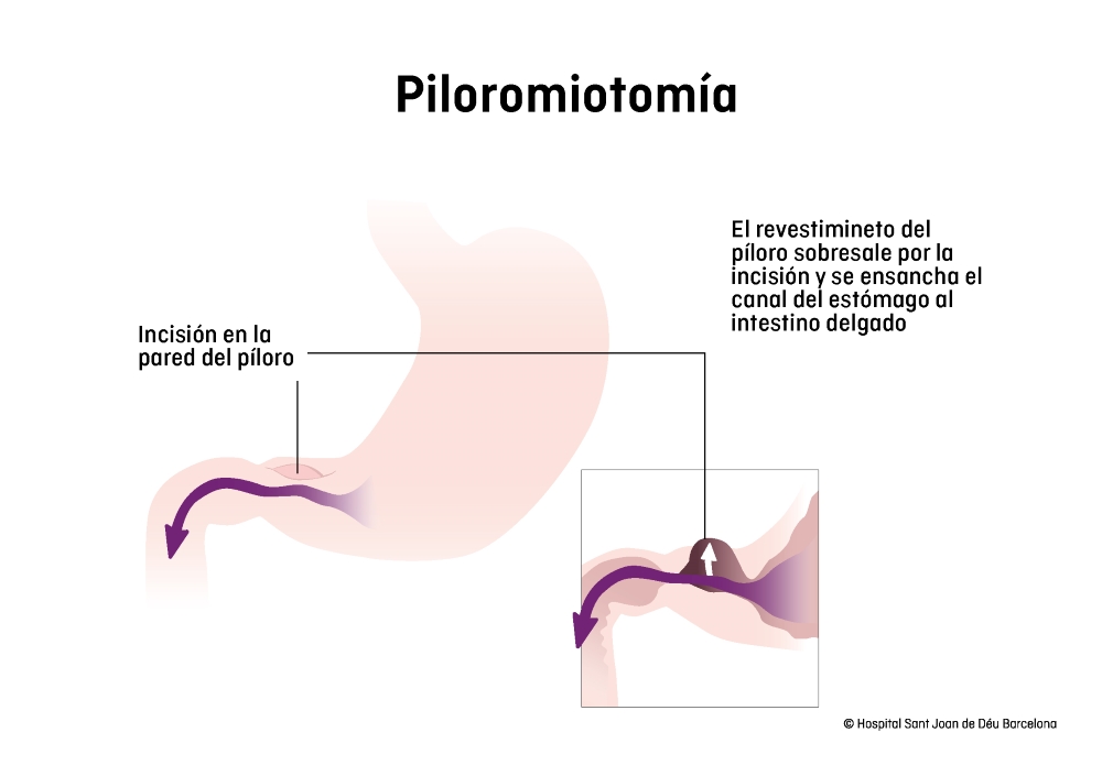 Dibujo de Piloromiotomía