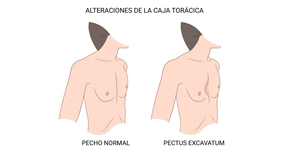 pectus excavatum
