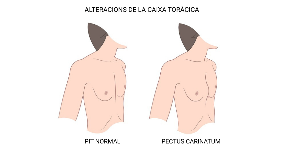 pectus carinatum