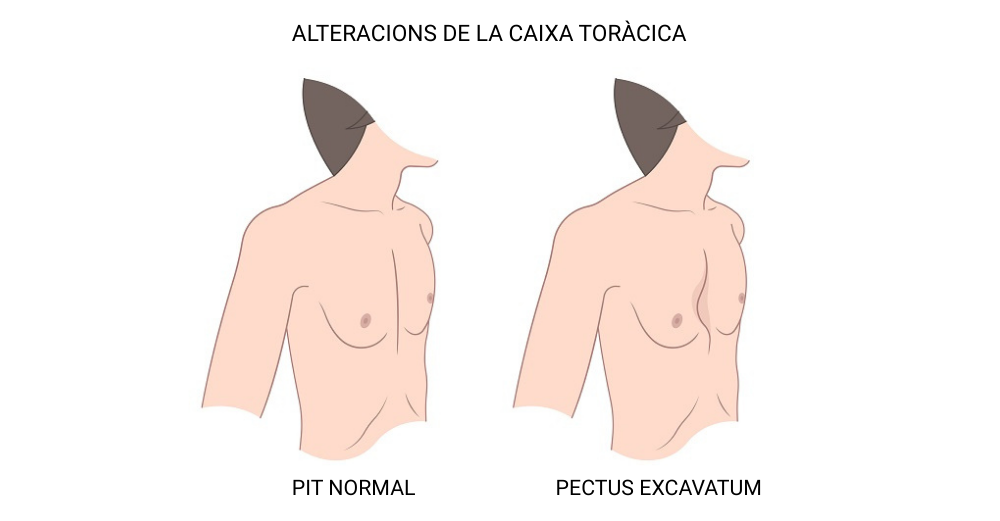 pectus excavatum