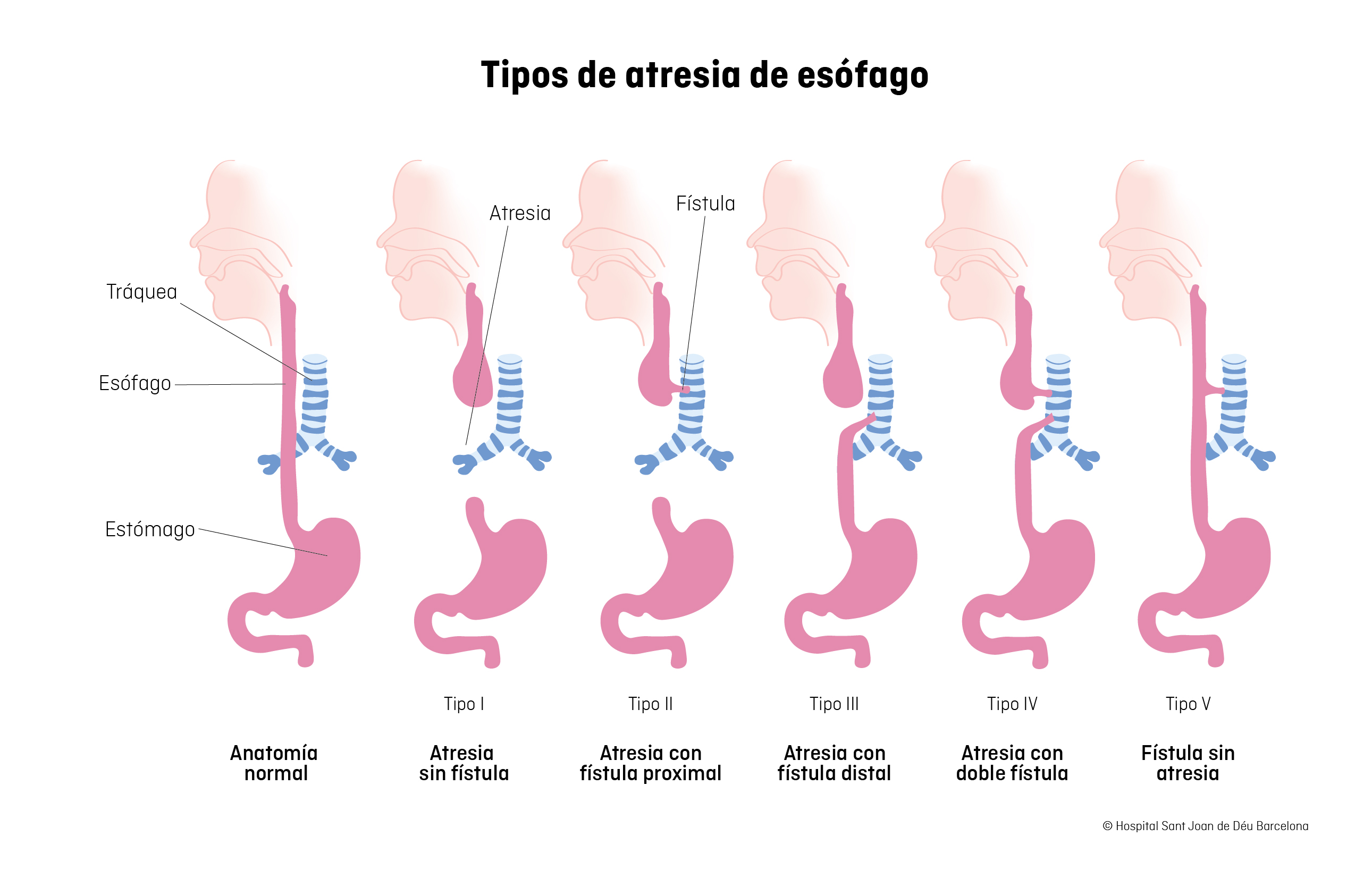 Atresia de esófago