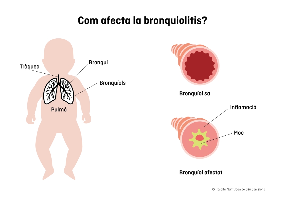 Dibuix d'un nen amb bronquiolitis