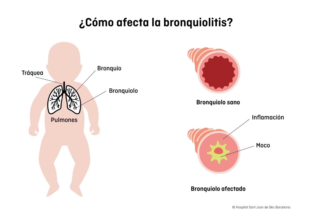 Dibujo de un niño con bronquiolitis