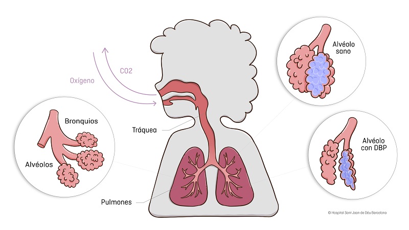 bronquiolitis