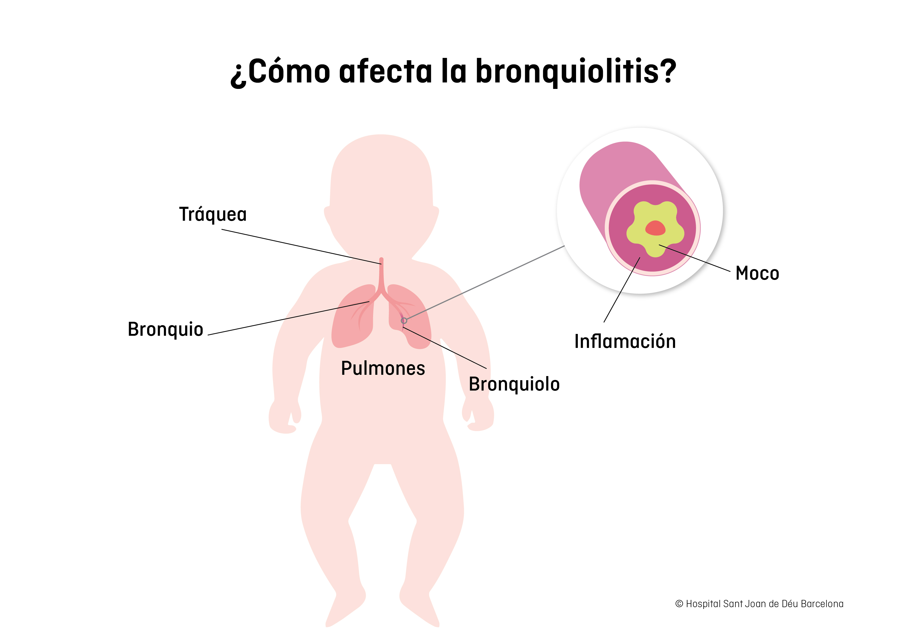 Bronquiolitis