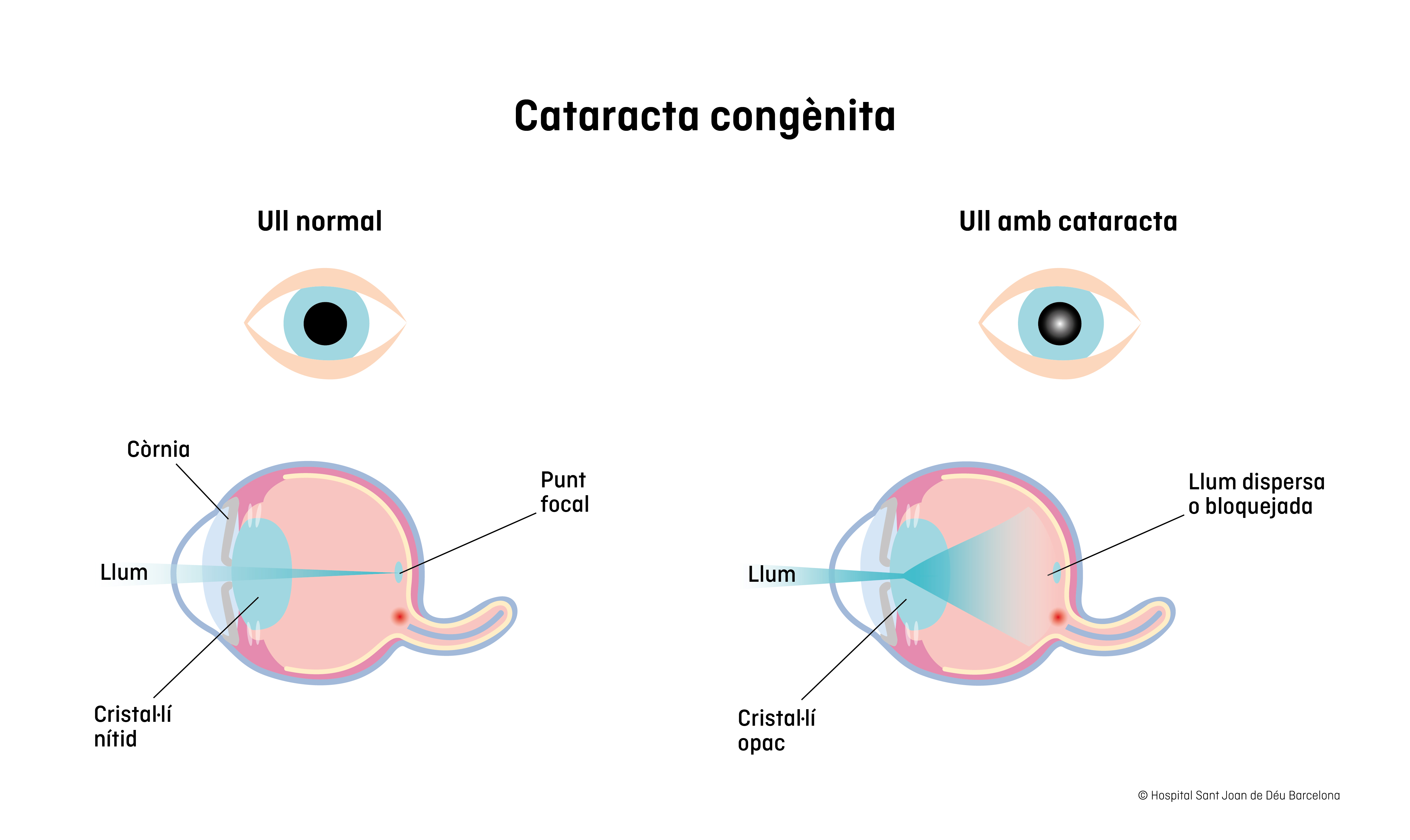 Catarata congénita